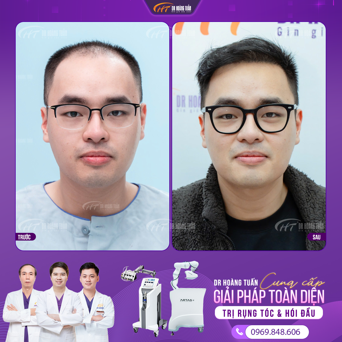 Cấy tóc được bao lâu
